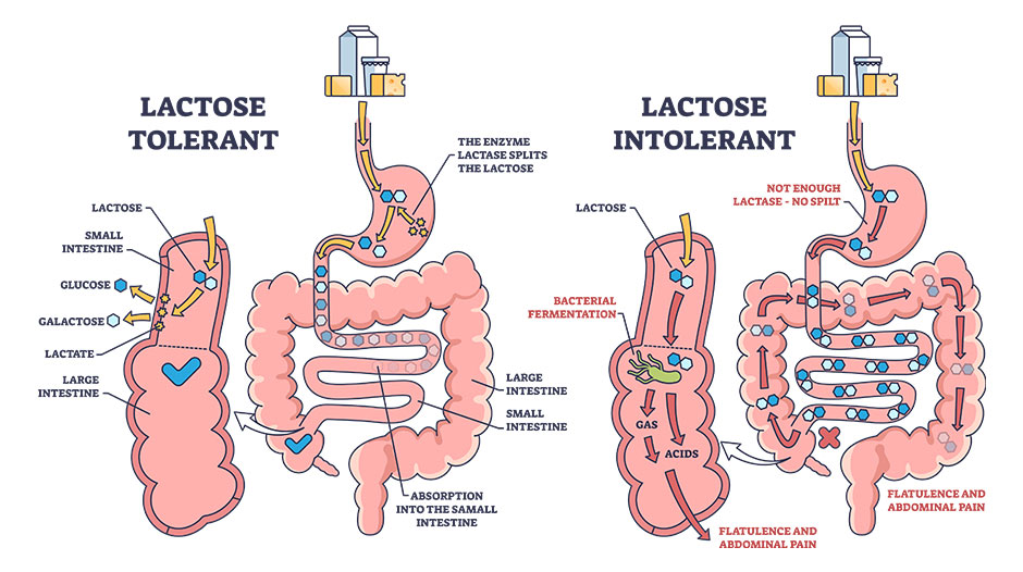 intolérance au lactose